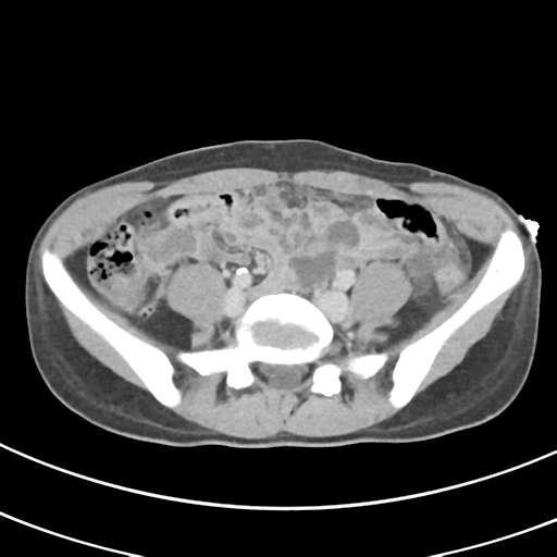 File:Abdominal multi-trauma - devascularised kidney and liver, spleen and pancreatic lacerations (Radiopaedia 34984-36486 Axial C+ delayed 55).png