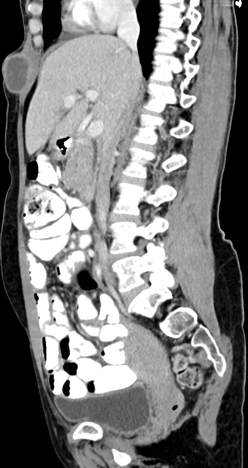 Abdominal wall and retroperitoneal tuberculosis (Radiopaedia 88137-104729 Sagittal C+ portal venous phase 87).jpg