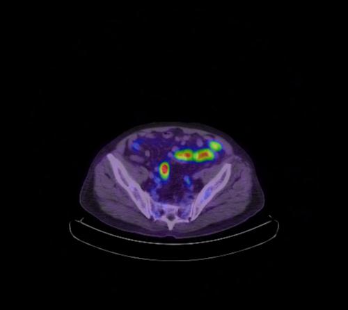 Abdominal wall metastasis from colorectal carcinoma (Radiopaedia 31016-31719 Axial 37).jpg