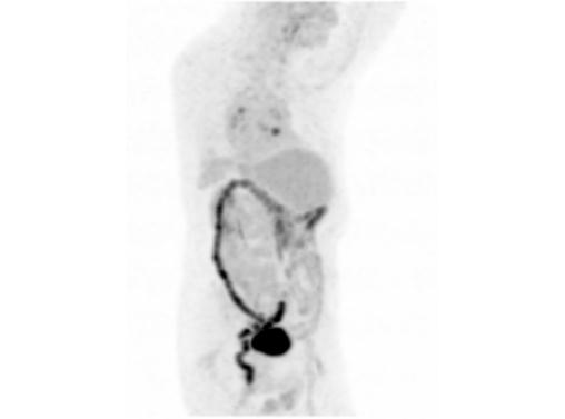 File:Abdominal wall metastasis from colorectal carcinoma (Radiopaedia 31016-31719 Rotational MIP 20).jpg