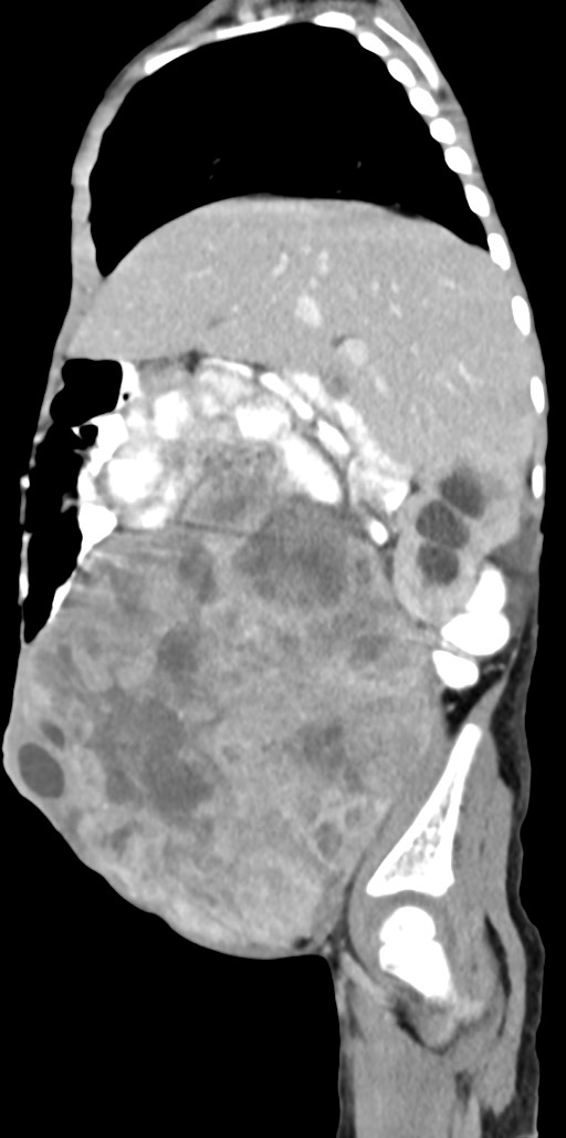 Abdominopelvic rhabdomyosarcoma (Radiopaedia 78356-90984 Sagittal C+ portal venous phase 68).jpg