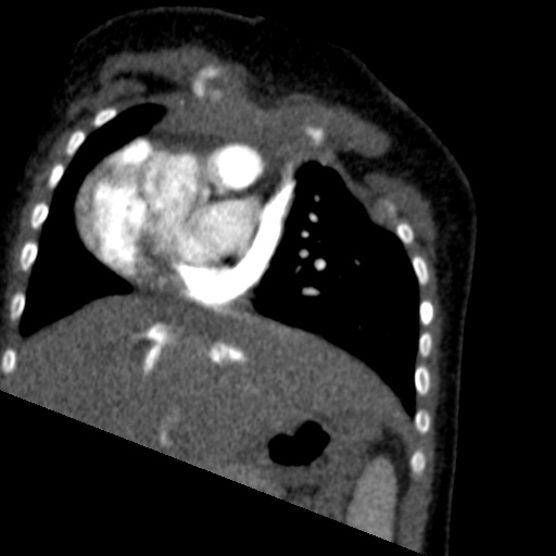 File:Aberrant left pulmonary artery (pulmonary sling) (Radiopaedia 42323-45435 Coronal C+ CTPA 17).jpg