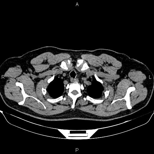 Aberrant right subclavian artery (Radiopaedia 87093-103354 Axial non-contrast 13).jpg