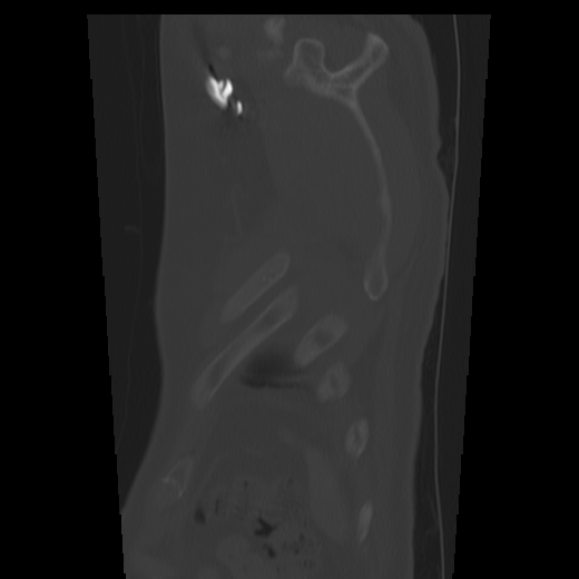 Aberrant right subclavian artery (arteria lusoria) (Radiopaedia 66584-75879 Sagittal C+ arterial phase 79).png