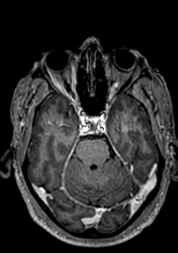 Accessory middle cerebral artery (Radiopaedia 73114-83828 Axial T1 C+ 99).jpg