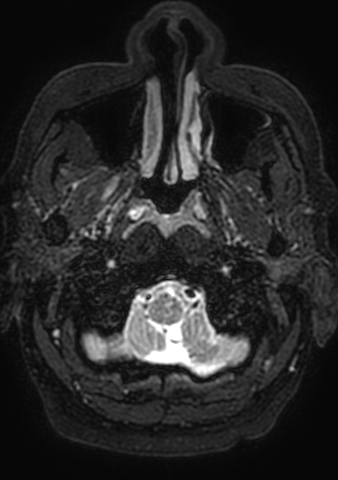Accessory middle cerebral artery (Radiopaedia 73114-83828 Axial T2 217).jpg