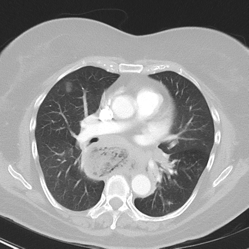 File:Achalasia (Radiopaedia 47147-51685 Axial lung window 25).png