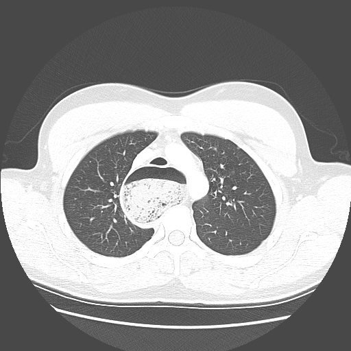 Achalasia (Radiopaedia 52507-58417 Axial lung window 18).jpg