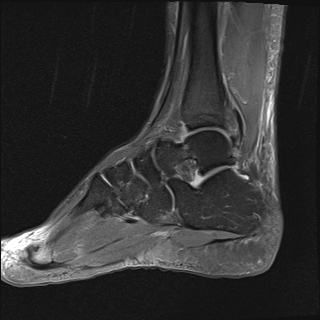 File:Achilles tendon tear (Radiopaedia 77615-89819 Sagittal PD fat sat 15).jpg