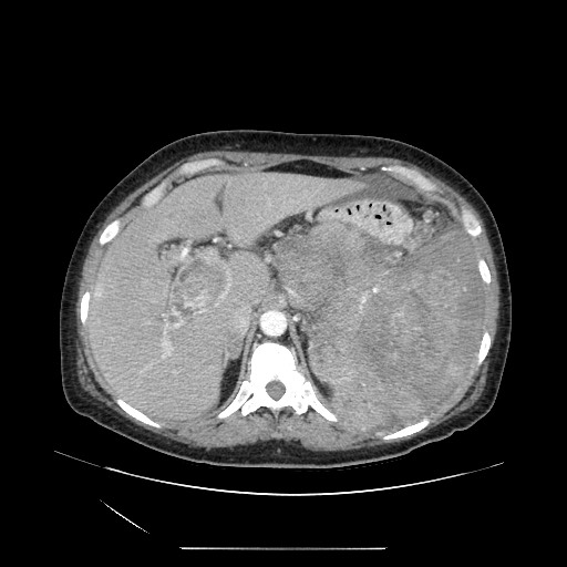 Acinar cell carcinoma of the pancreas (Radiopaedia 75442-86669 Axial C+ portal venous phase 34).jpg