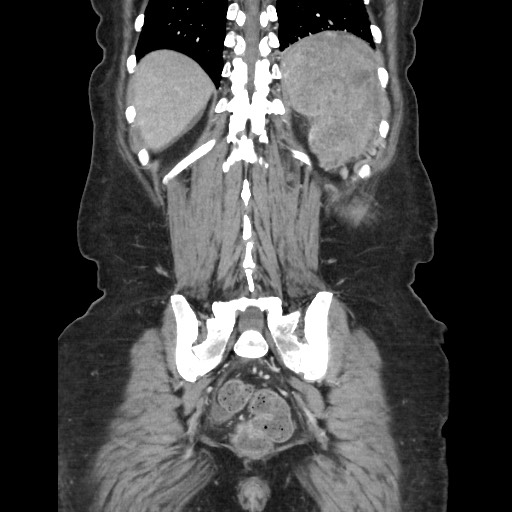 Acinar cell carcinoma of the pancreas (Radiopaedia 75442-86669 Coronal C+ portal venous phase 102).jpg