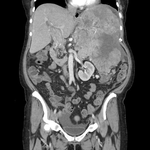Acinar cell carcinoma of the pancreas (Radiopaedia 75442-86669 Coronal C+ portal venous phase 60).jpg