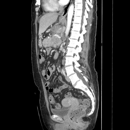 File:Acinar cell carcinoma of the pancreas (Radiopaedia 75442-86669 Sagittal C+ portal venous phase 102).jpg