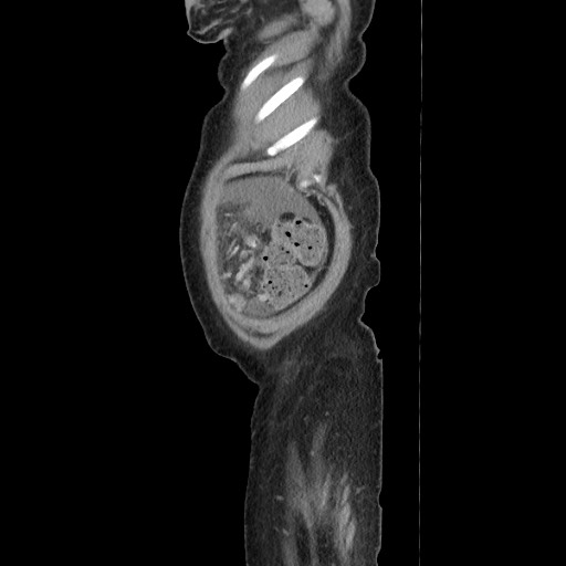 Acinar cell carcinoma of the pancreas (Radiopaedia 75442-86669 Sagittal C+ portal venous phase 179).jpg