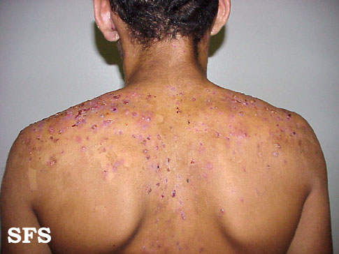 File:Acne (Dermatology Atlas 9).jpg