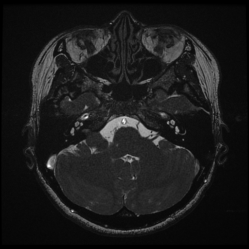 Acoustic neuroma (Radiopaedia 34049-35283 Axial 47).png