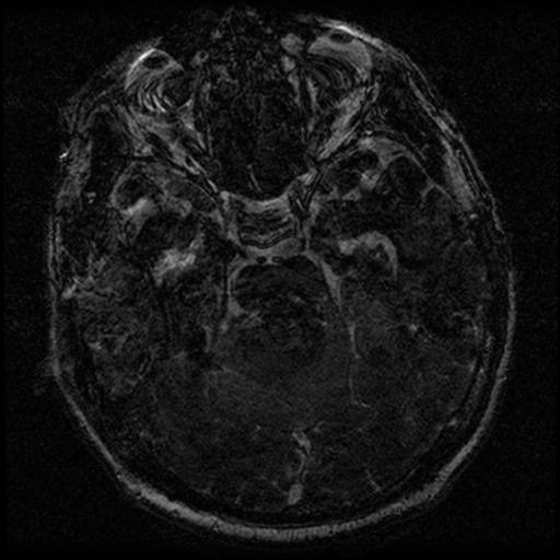 File:Acoustic schwannoma (Radiopaedia 39170-41387 Axial FIESTA 109).png