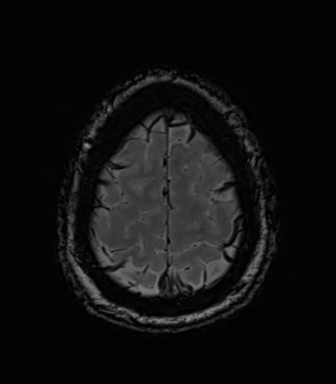File:Acoustic schwannoma (Radiopaedia 50846-56358 Axial SWI 83).png