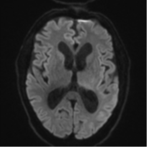 Acoustic schwannoma (Radiopaedia 55729-62281 E 41).png