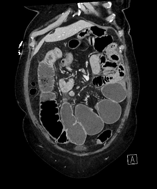 Active Crohn disease (Radiopaedia 59394-66750 Coronal C+ portal venous phase 21).jpg