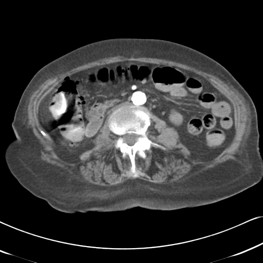 File:Active bleeding from duodenal ulcer with embolization (Radiopaedia 34216-35481 Axial C+ arterial phase 30).png