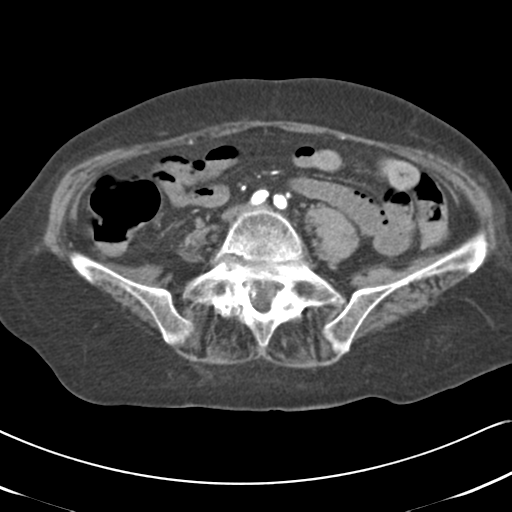 File:Active bleeding from duodenal ulcer with embolization (Radiopaedia 34216-35481 Axial C+ arterial phase 41).png