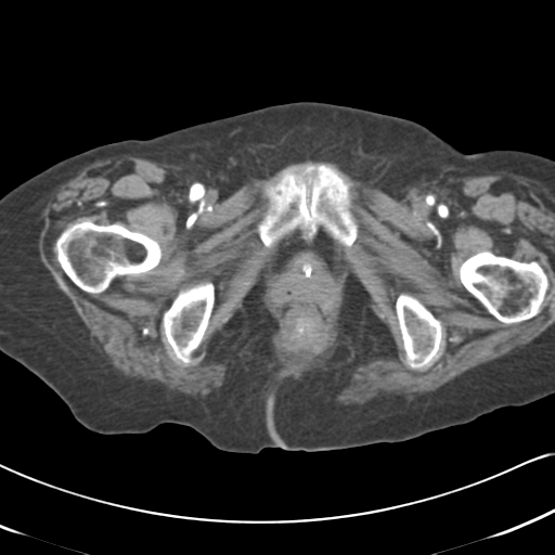 File:Active bleeding from duodenal ulcer with embolization (Radiopaedia 34216-35481 Axial C+ arterial phase 70).png