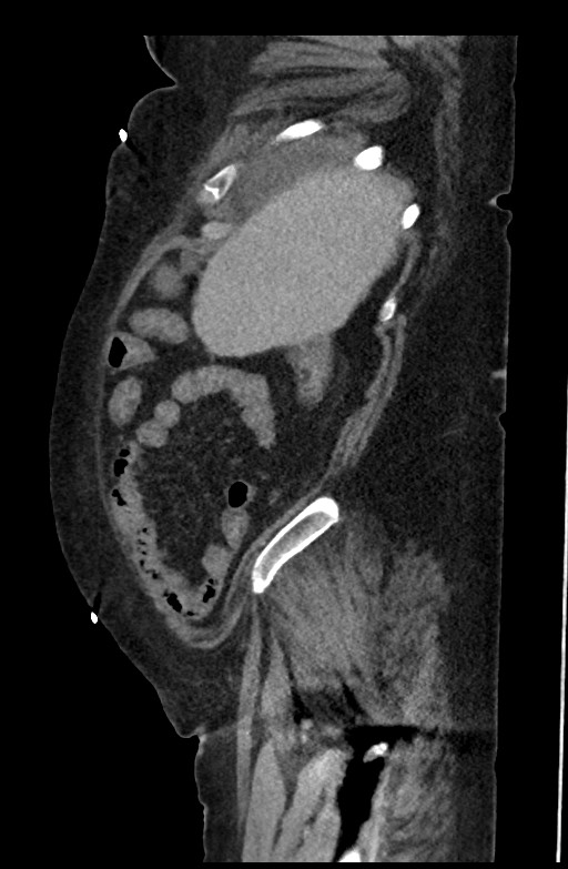 Active renal extravasation with large subcapsular and retroperitoneal hemorrhage (Radiopaedia 60975-68796 Sagittal C+ portal venous phase 181).jpg