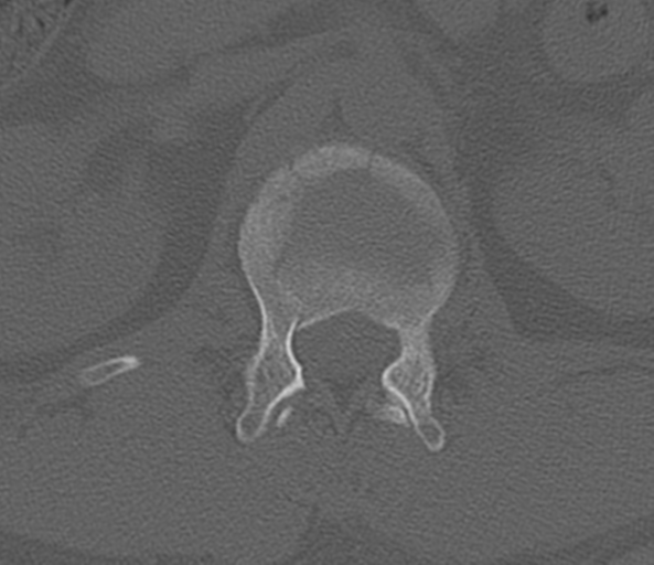 File:Acute L1 burst compression fracture (Radiopaedia 34430-35755 Axial bone window 19).png