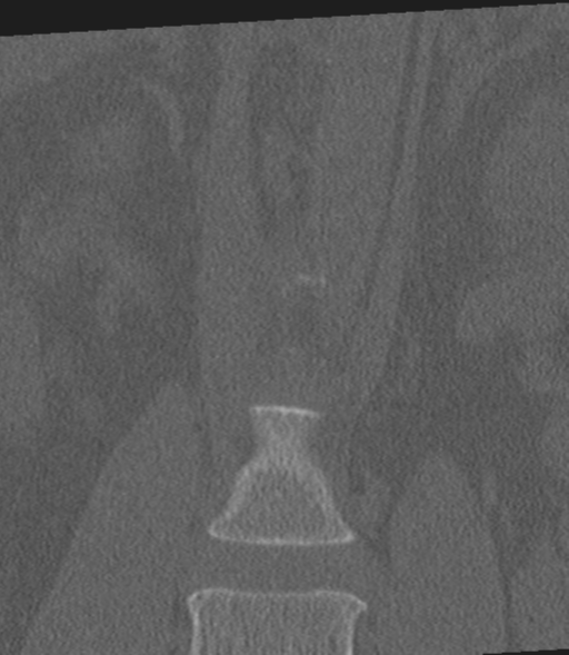 Acute L1 burst compression fracture (Radiopaedia 34430-35755 Coronal bone window 11).png