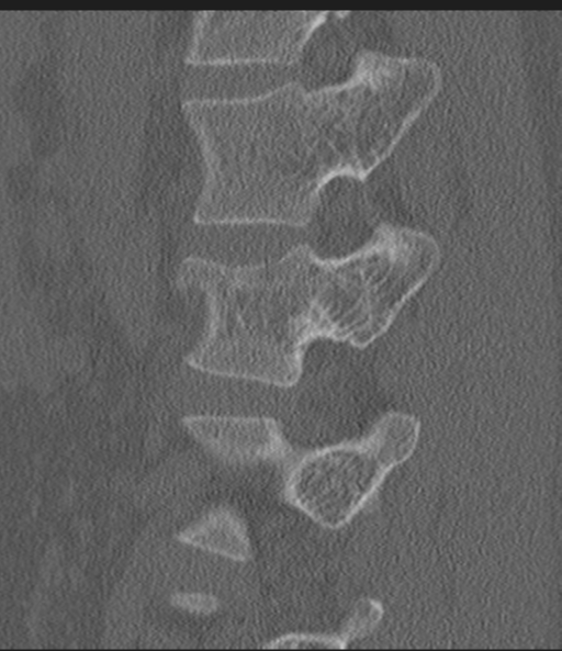 File:Acute L1 burst compression fracture (Radiopaedia 34430-35755 Sagittal bone window 21).png