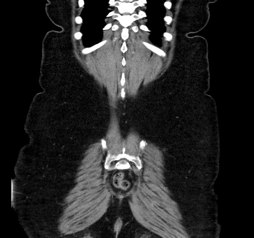 Acute appendicitis, heterotaxy syndrome (Radiopaedia 66884-76202 Coronal C+ portal venous phase 112).jpg