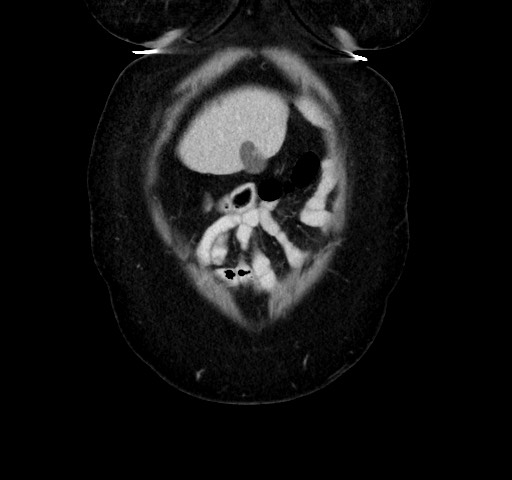 Acute appendicitis, heterotaxy syndrome (Radiopaedia 66884-76202 Coronal C+ portal venous phase 13).jpg