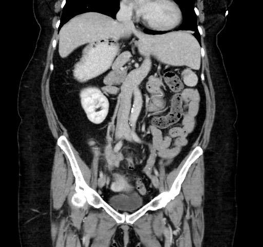 Acute appendicitis, heterotaxy syndrome (Radiopaedia 66884-76202 Coronal C+ portal venous phase 60).jpg