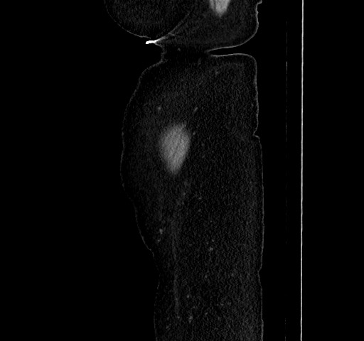 Acute appendicitis, heterotaxy syndrome (Radiopaedia 66884-76202 Sagittal C+ portal venous phase 125).jpg
