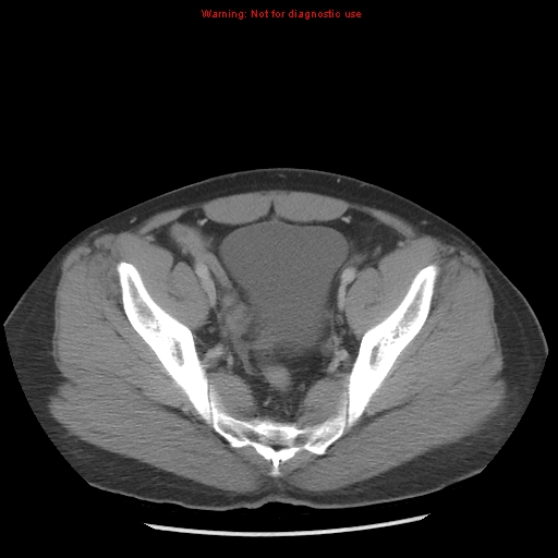 Acute appendicitis (Radiopaedia 10498-10973 Axial C+ portal venous phase 45).jpg