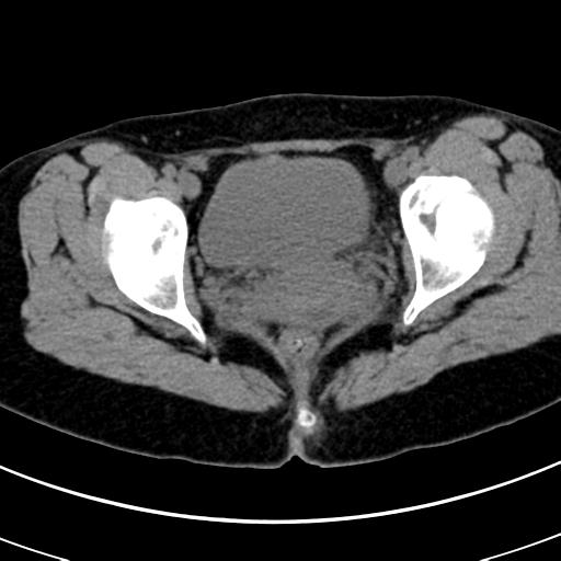 Acute appendicitis (Radiopaedia 30261-30888 Axial non-contrast 101).jpg