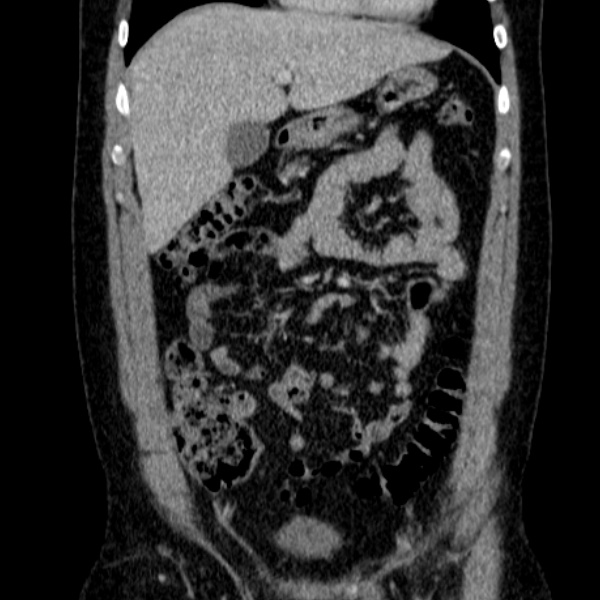 Acute appendicitis (Radiopaedia 38255-40270 Coronal C+ portal venous phase 30).jpg