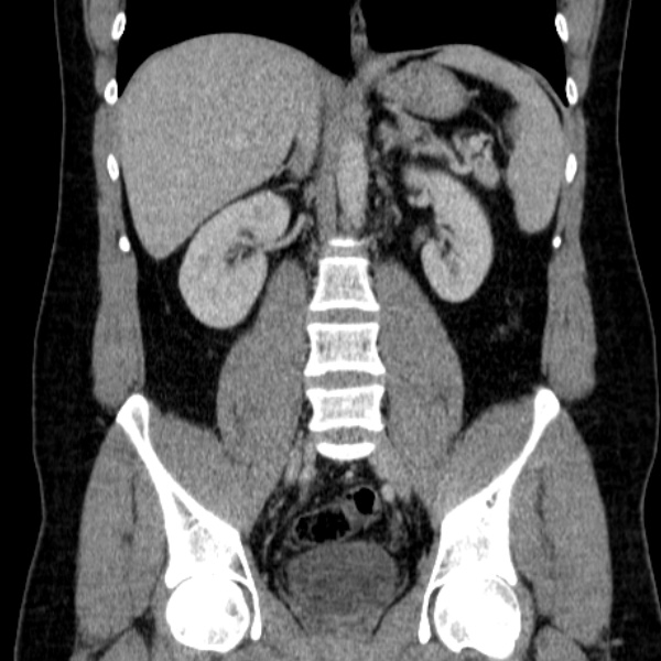 Acute appendicitis (Radiopaedia 38255-40270 Coronal C+ portal venous phase 51).jpg