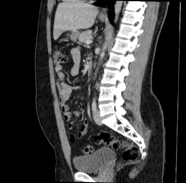 Acute appendicitis (Radiopaedia 38255-40270 Sagittal C+ portal venous phase 46).jpg