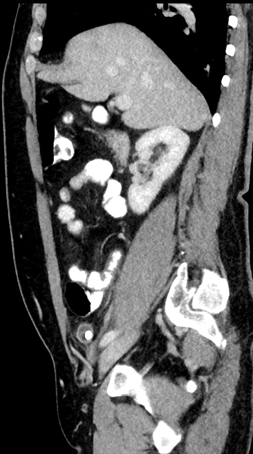 Acute appendicitis (Radiopaedia 77016-88960 Sagittal C+ portal venous phase 75).jpg