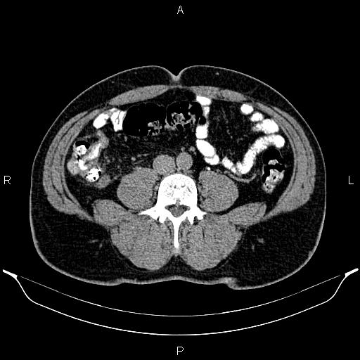 File:Acute appendicitis (Radiopaedia 84780-100240 Axial C+ delayed 63).jpg