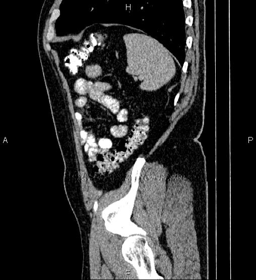 Acute appendicitis (Radiopaedia 84780-100240 Sagittal C+ portal venous phase 89).jpg