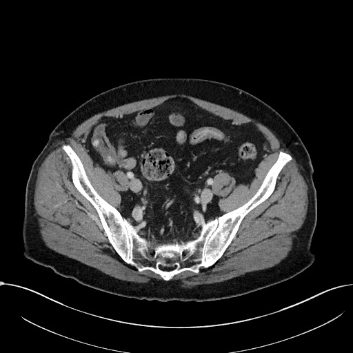 File:Acute appendicitis - large appendicoliths (Radiopaedia 61805-69820 Axial C+ portal venous phase 102).jpg