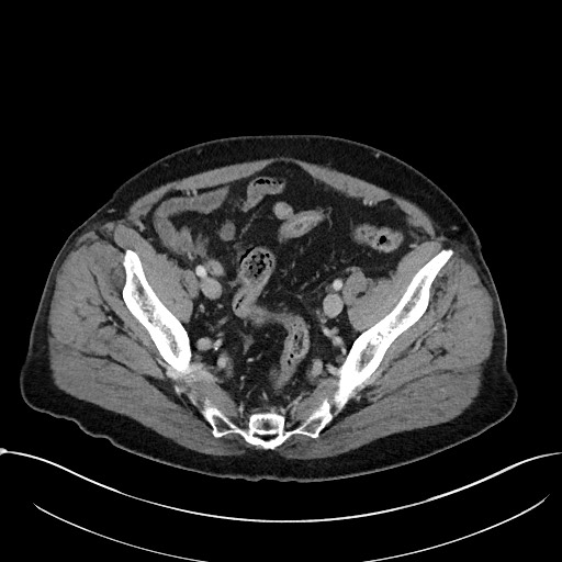 File:Acute appendicitis - large appendicoliths (Radiopaedia 61805-69820 Axial C+ portal venous phase 106).jpg