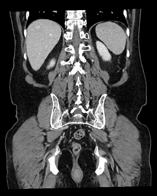 Acute appendicitis - large appendicoliths (Radiopaedia 61805-69820 Coronal C+ portal venous phase 104).jpg