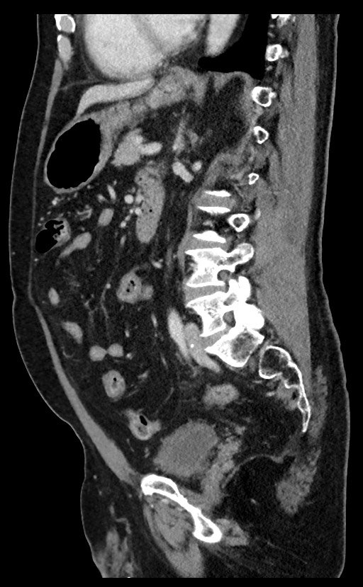 Acute appendicitis - large appendicoliths (Radiopaedia 61805-69820 Sagittal C+ portal venous phase 49).jpg