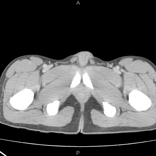 File:Acute appendicitis with CT arrowhead sign (Radiopaedia 21474-21411 Axial C+ portal venous phase 43).jpg