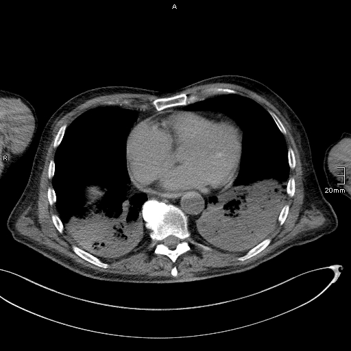 Acute aspiration pneumonitis (Radiopaedia 55642-62166 Axial liver window 43).jpg
