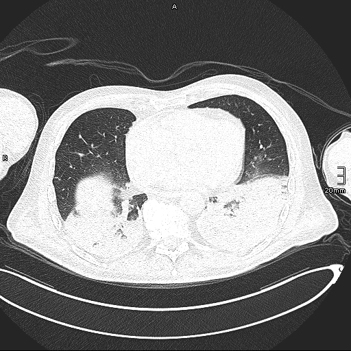 Acute aspiration pneumonitis (Radiopaedia 55642-62166 Axial lung window 107).jpg